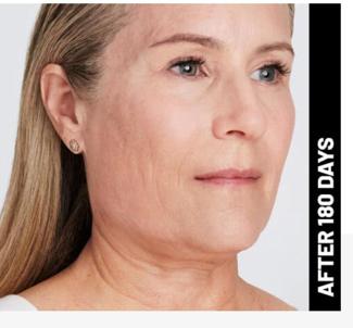 Ultherapy Before & After Patient #1545